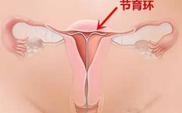 【節(jié)育環(huán)】節(jié)育環(huán)何時(shí)取出_帶哪種節(jié)育環(huán)好_取避孕環(huán)需要多少錢_上節(jié)育環(huán)后吃什么 【節(jié)育環(huán)】節(jié)育環(huán)何時(shí)取出_帶哪種節(jié)育環(huán)好_取避孕環(huán)需要多少錢_上節(jié)育環(huán)后吃什么