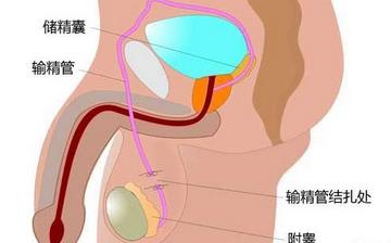 【男性結(jié)扎】男性結(jié)扎手術(shù)_結(jié)扎手術(shù)對(duì)男性的影響_男性結(jié)扎注意什么 【男性結(jié)扎】男性結(jié)扎手術(shù)_結(jié)扎手術(shù)對(duì)男性的影響_男性結(jié)扎注意什么