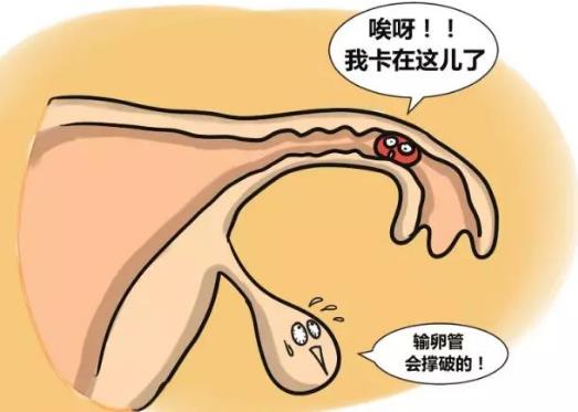 輸卵管妊娠的自我檢查、癥狀及治療方法