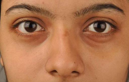 黑眼圈不僅是因?yàn)槟I虛 黑眼圈透露你身體的健康問(wèn)題