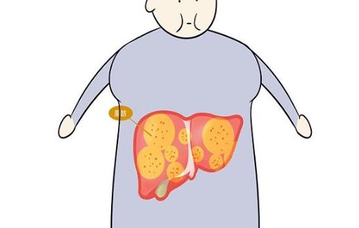 因?yàn)橐患?，有人脂肪肝逆轉(zhuǎn)回正常，有人演變成癌！就怕