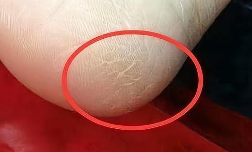 手腳脫皮的原因 八種方法預(yù)防腳脫皮