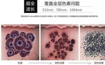 寧波薇琳整形醫(yī)院祛斑怎么樣？還您一張漂亮的容顏