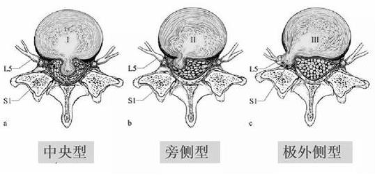 患上腰椎病，一定不能拖！內(nèi)鏡微創(chuàng)手術(shù)，一步治好它！