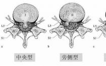 患上腰椎病，一定不能拖！內(nèi)鏡微創(chuàng)手術(shù)，一步治好它！