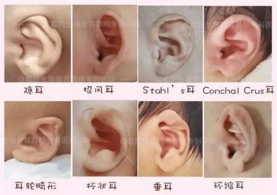 新生兒耳廓畸形能矯正嗎？看成都民生耳鼻喉醫(yī)院如何支招