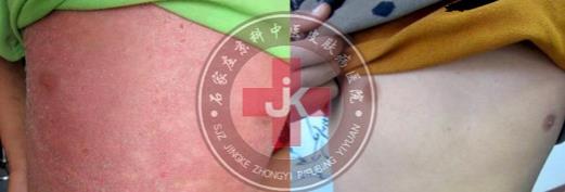 許光生：多年兒童牛皮癬終于治好，兒童牛皮癬怎么治