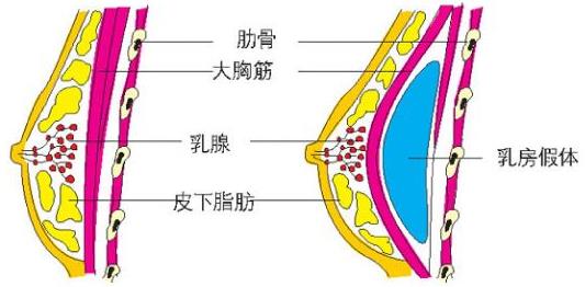 原來假體隆胸還可以這樣解釋！