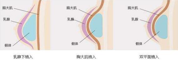 原來假體隆胸還可以這樣解釋！