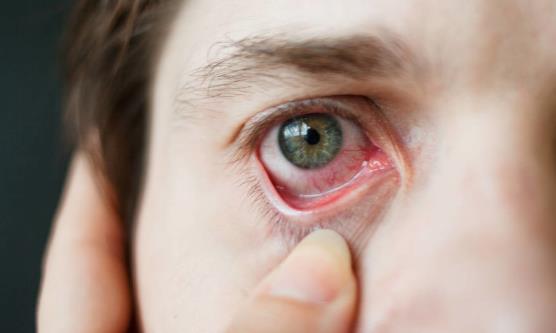 紅血絲青睞眼部和臉上 要怎么有效擺脫？