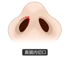 北京圣慈整形醫(yī)院鼻子王王軍怎么樣？專業(yè)實力 讓你放心美