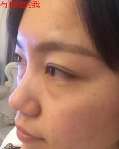 衛(wèi)婭日記：我一直都以為眼袋對(duì)我的影響只是美觀，直到我了解了以后……