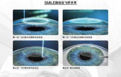 西安普瑞眼科醫(yī)院治療近視好？參軍入伍，近視手術(shù)提前半年做準(zhǔn)備