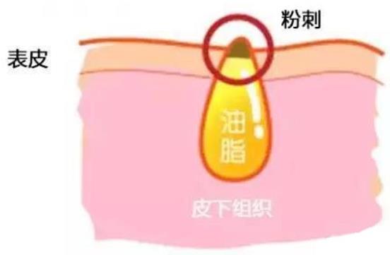 甲硝唑凝膠去黑頭要看主流，別拿個體差異混淆視聽