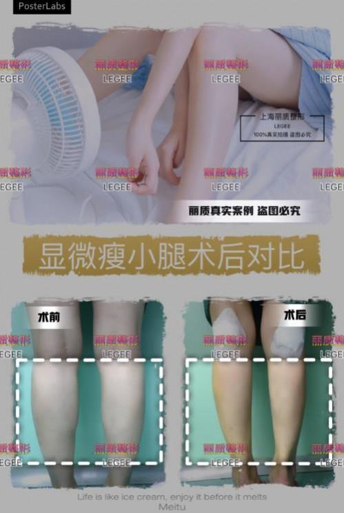 上海麗質(zhì)美學整形門診部做瘦小腿價格貴嗎？肌肉小腿太難減怎么辦