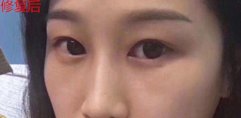 君雅筆記：眼袋過重，就會顯得比真實年齡大，要如何修復(fù)眼袋呢？