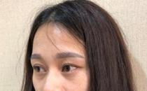 君雅筆記：眼袋過(guò)重，就會(huì)顯得比真實(shí)年齡大，要如何修復(fù)眼袋呢？