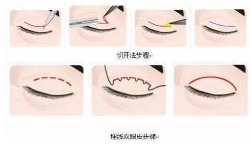 上海玫瑰整形醫(yī)院雙眼皮手術(shù)怎么樣？輕松擁有靚麗雙眼
