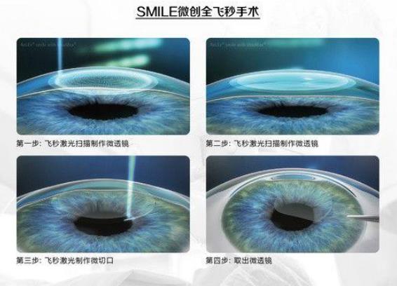 西安普瑞眼科醫(yī)院好嗎？戴眼鏡VS近視手術(shù)，四個(gè)對比讓你不糾結(jié)