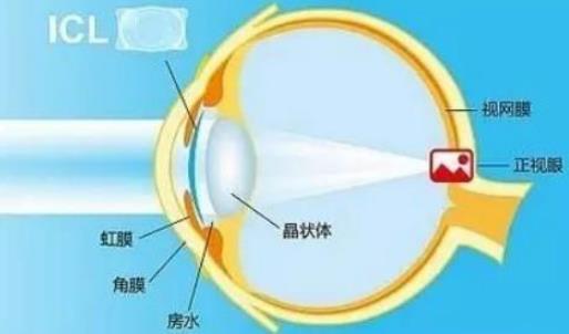 西安普瑞眼科醫(yī)院好嗎？戴眼鏡VS近視手術(shù)，四個(gè)對比讓你不糾結(jié)