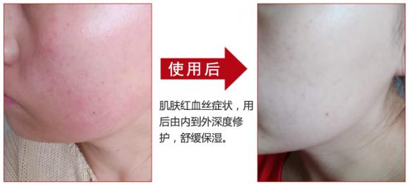 放心！有美薏升修復(fù)敏感肌紅血絲專家產(chǎn)品在，你每天都可以美美噠