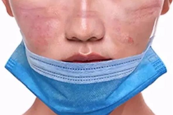 長期戴口罩痘痘叢生？有甲硝唑凝膠祛痘不用慌