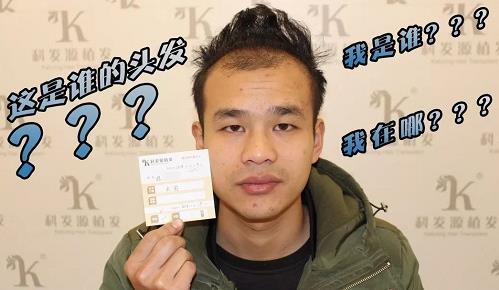 青島大麥微針植發(fā)2500毛囊單位，術(shù)后8個月恢復(fù)頭發(fā)濃密